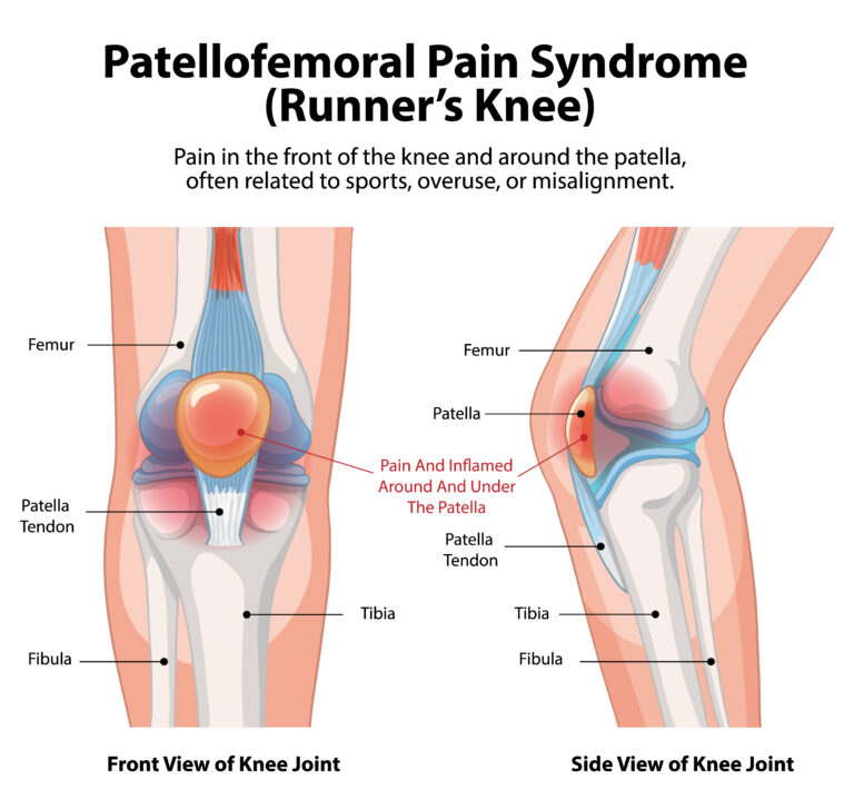 patellofemoral-pain-syndrome